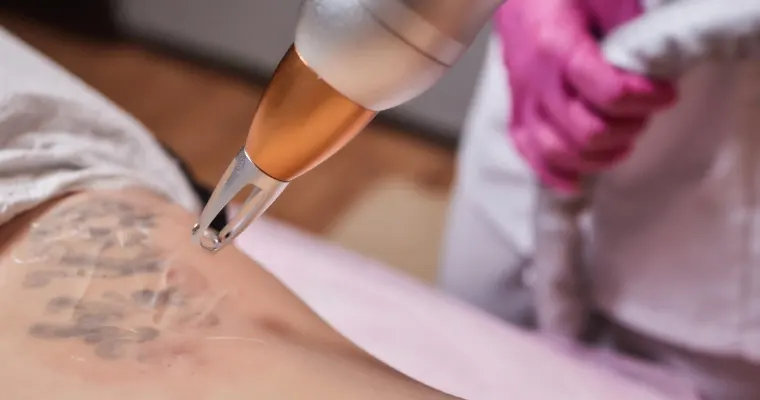 Laser Tattoo Removal