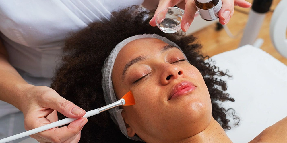 Chemical Peel