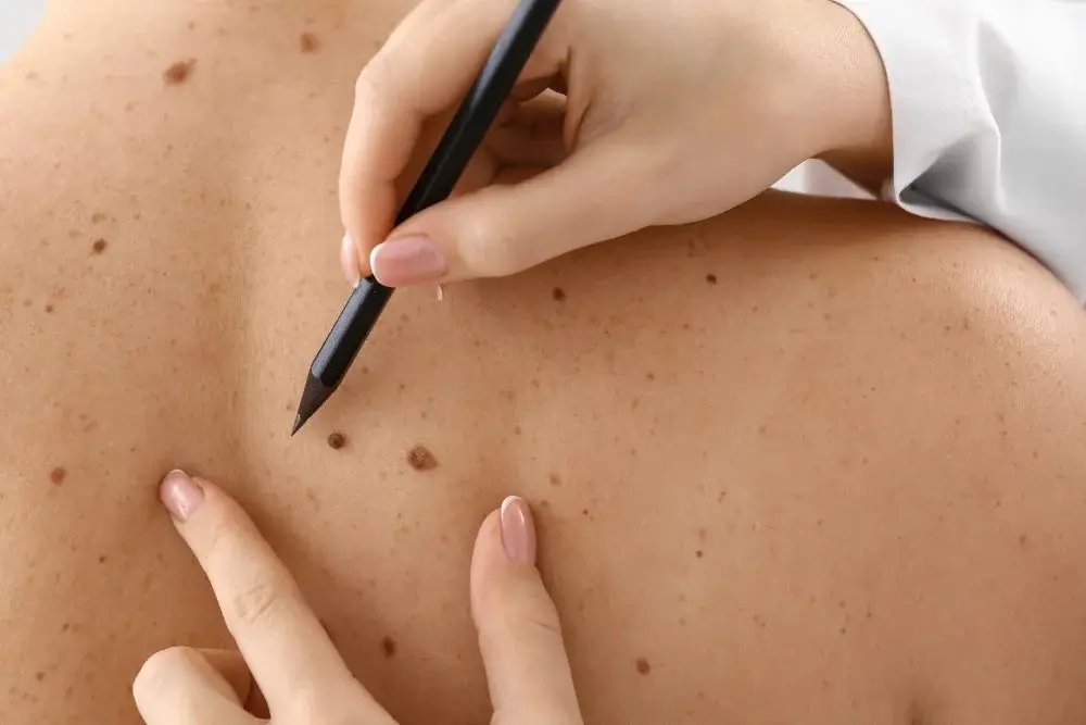 Skin Tags and Wart Removal