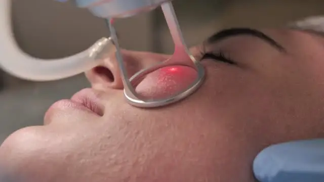 Fractional Laser treatment
