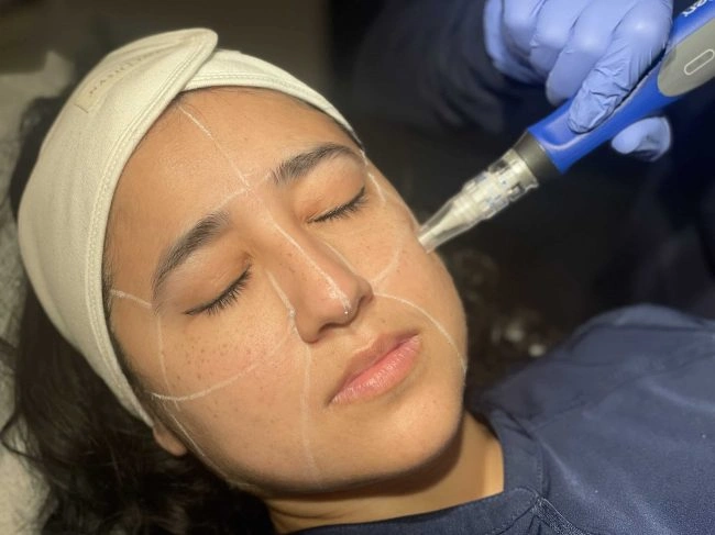 Microneedling with Korean GFC